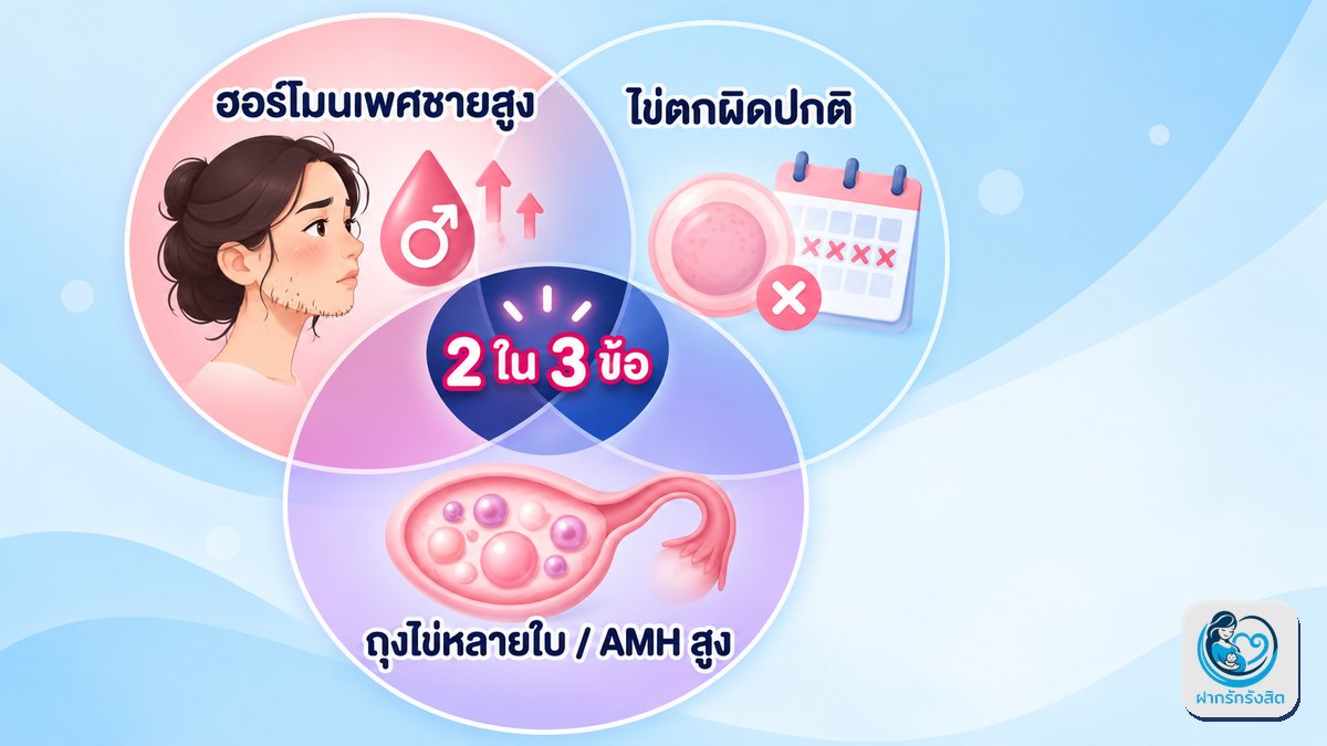 เกณฑ์วินิจฉัย PCOS ตามแนวทางสากล